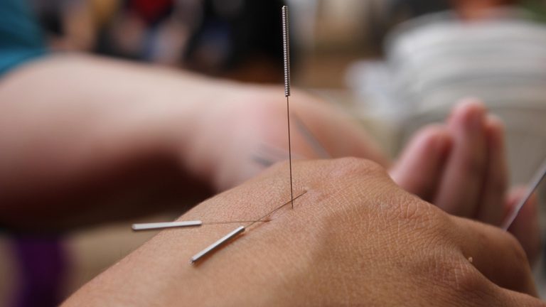 非耳石症的嚴重眩暈：頸椎錯位的正骨針灸個案